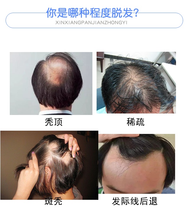 脱发-4