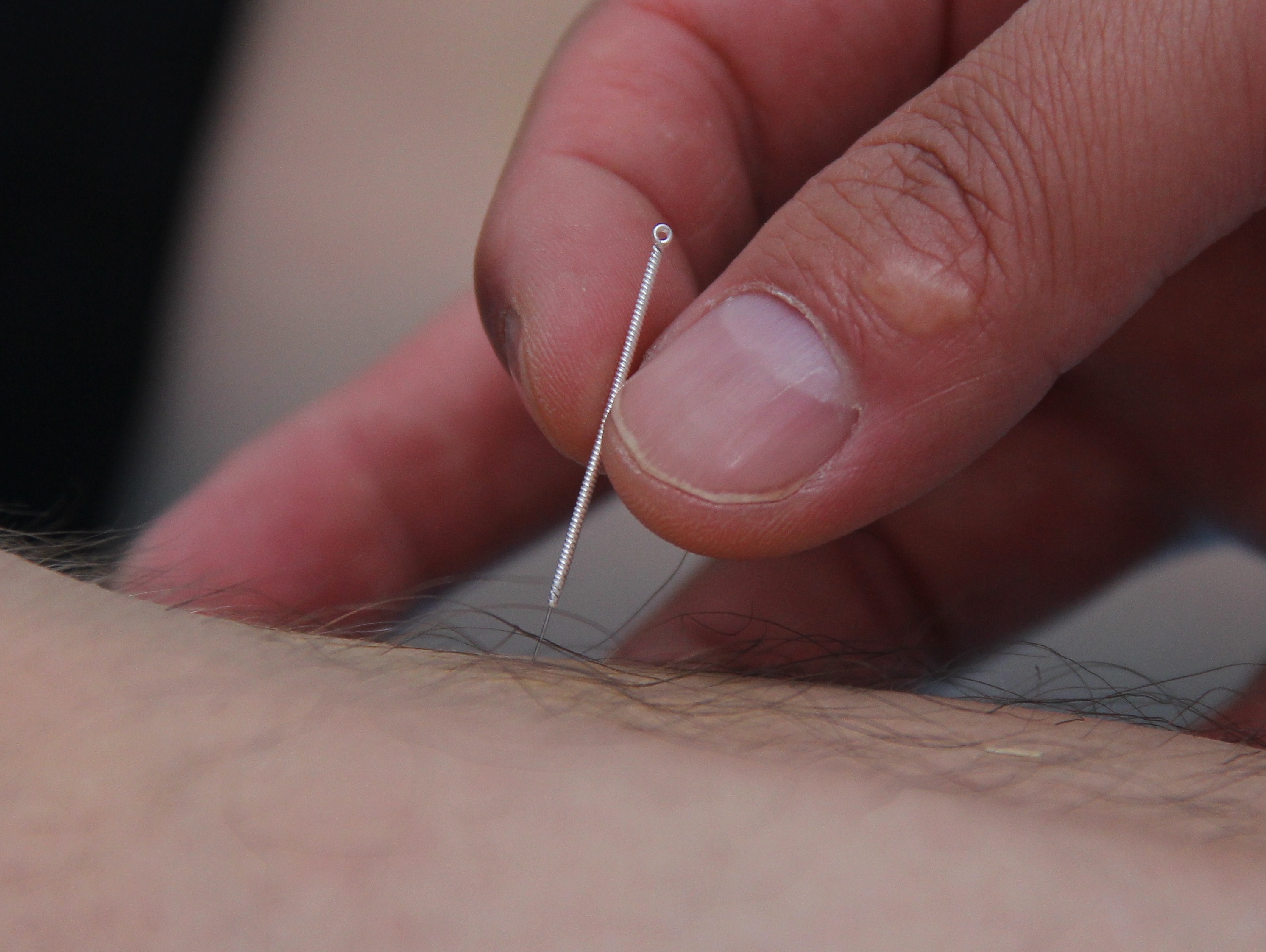 新乡潘剑中医潘剑主任针灸图